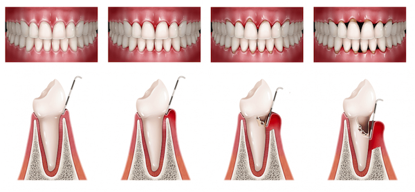 bolsa periodontal