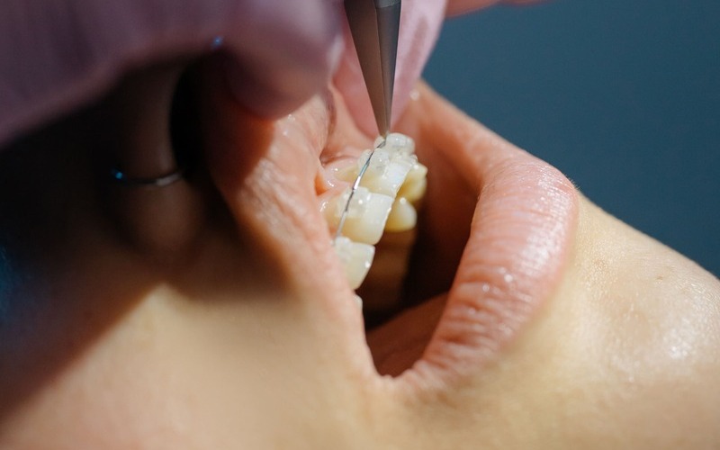Brackets de porcelana o cerámica