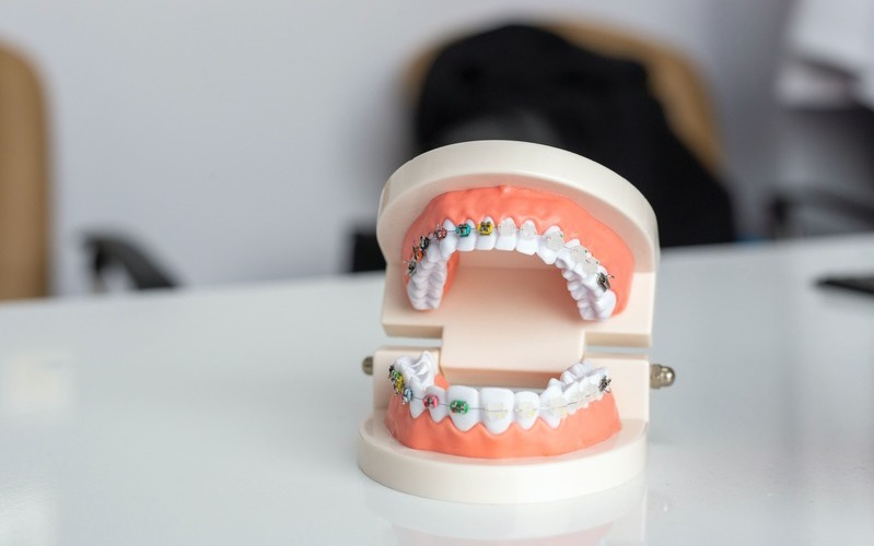 Brackets de zafiro vs brackets metálicos