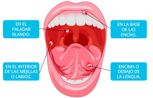 llagas en la lengua