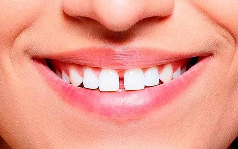 Cómo se soluciona el diastema