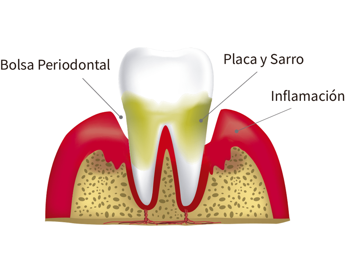 bolsa periodontal